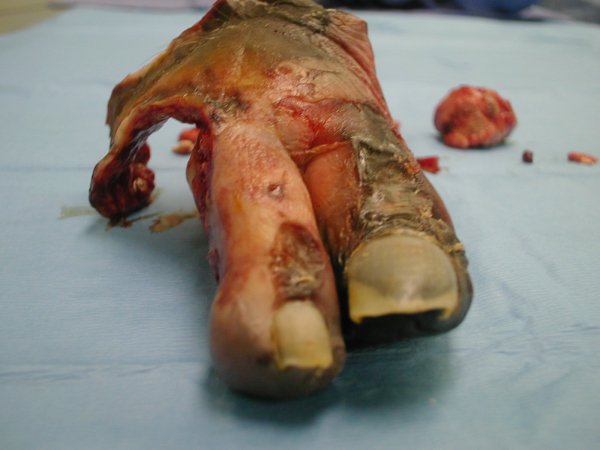 Gangrene08